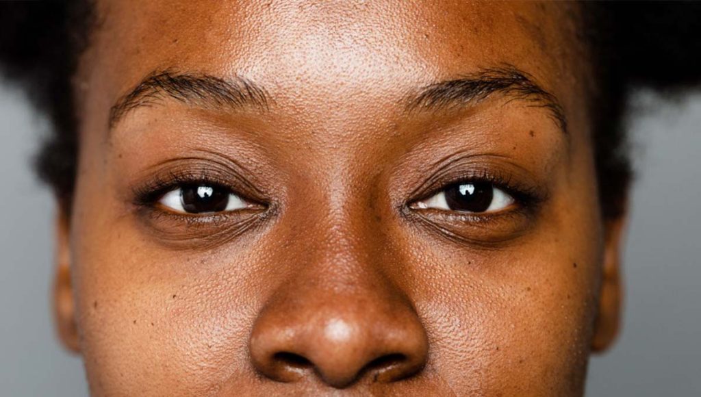 How Can You Prevent Dark Spots on Your Face?