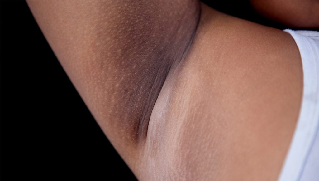 What Causes Dark Underarms?