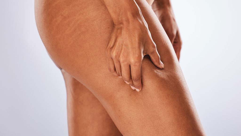 Say Goodbye to Crepey Skin on Your Legs